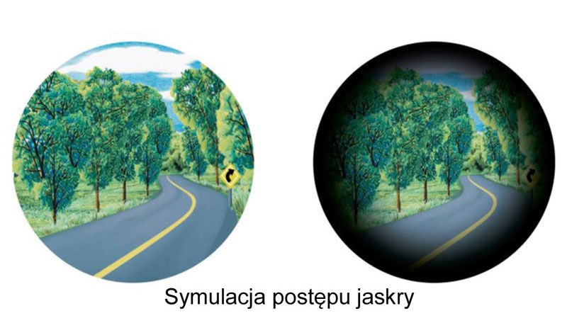 Ogólnopolska kampania edukacyjna: ''Jaskra nie boli – kradnie wzrok''